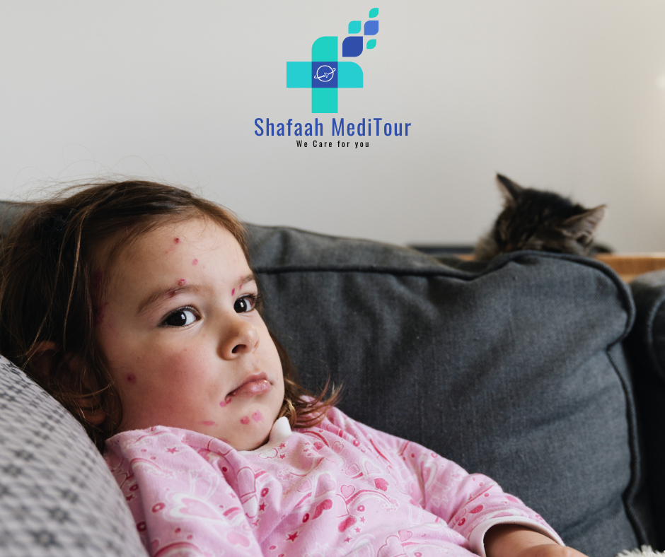 Chickenpox: Myths vs Facts — The Truth You Can’t Afford to Ignore